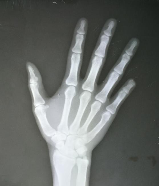 便携式DR