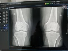 X线小焦点的特点与影响